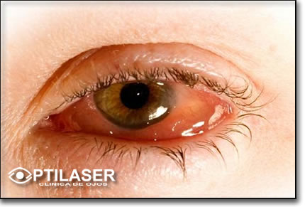 Clinica de ojos Optilaser - Conjuntivitis
